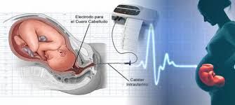 Monitorización de la frecuencia cardiaca fetal