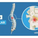 Abordaje Multidisciplinar de la Lesión Medular (LM)
