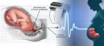 Monitorización de la frecuencia cardiaca fetal