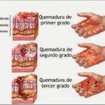 Cuidados de Enfermería en pacientes con quemaduras
