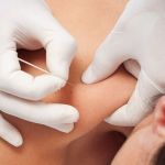 PUNCION SECA EN EL SINDROME DEL DOLOR MIOFASCIAL