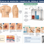 TÉCNICAS DE INSERCIÓN Y MANEJO DEL DRENAJE TORÁCICO ED-1